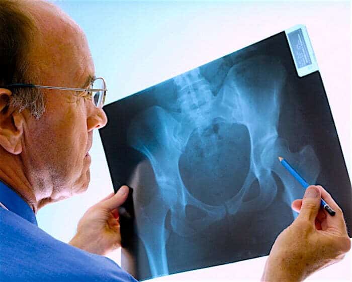 What is the life expectancy of an elderly person with a broken hip?